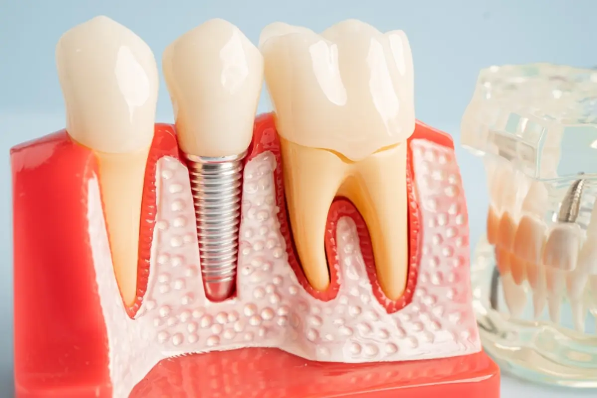 Implant